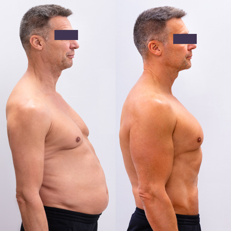 UltraSlim weight loss Riverside CA Weight Loss Before After