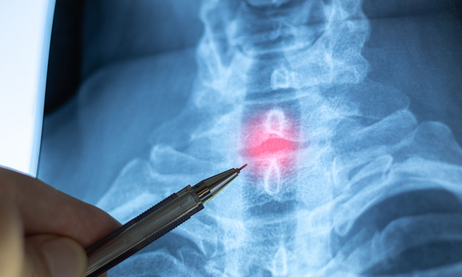 how many spinal decompression sessions