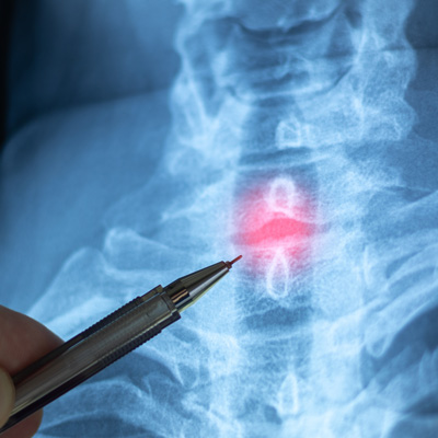 how many spinal decompression sessions