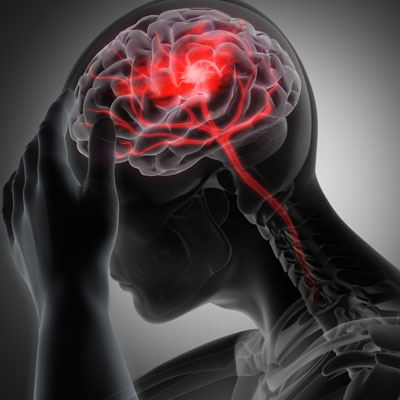 Cervicogenic Headache