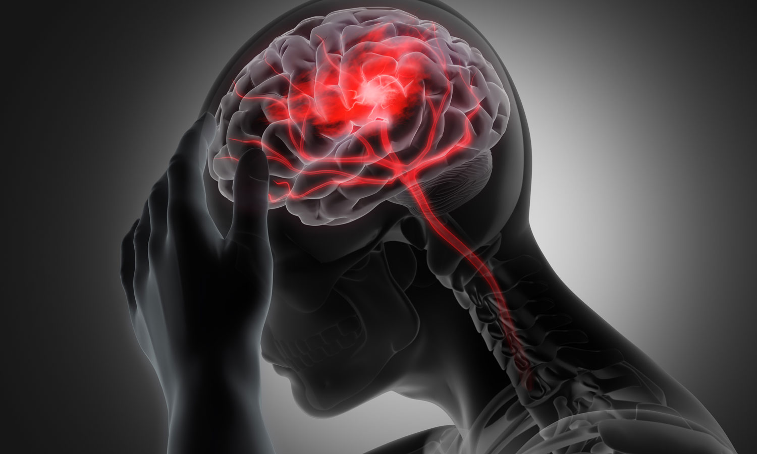 Cervicogenic Headache