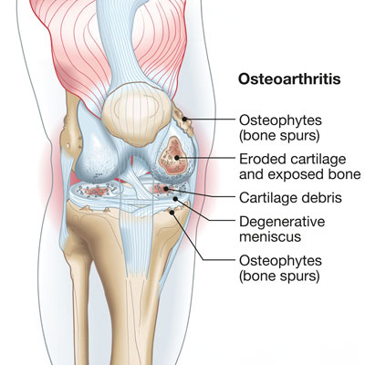 Osteoarthritis