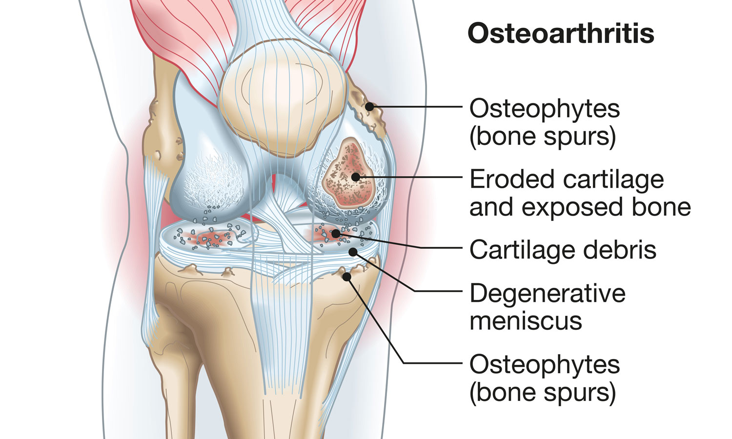 Osteoarthritis